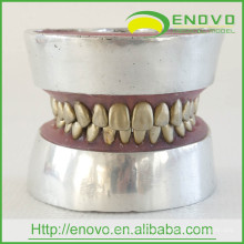 EN-E11 Metallzahn-Zahn-Extraktions-Praxis-Modell für Doktor Preoperative Praxis